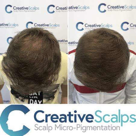 Your follicles lack essential nutrients. SMP, Scalp Micropigmentation for Thinning Hair | Creative ...
