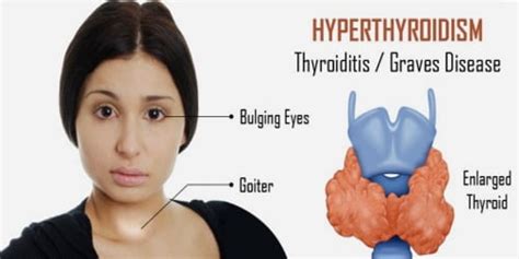 Hyperthyroidism Causes Risk Factors And Complications Assignment