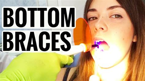 braces update getting my bottom braces on for the first time vlog youtube
