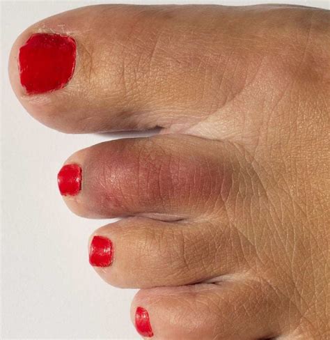 Broken Toe Treatments Symptoms Pictures And Healing Time