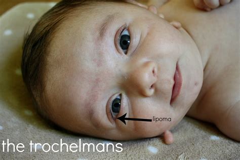 The Trochelmans Newborn Limbal Dermoidsgoldenhar Syndrome