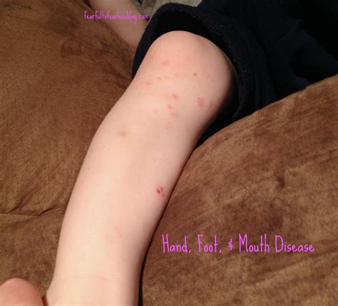 Hand Foot And Mouth Disease How To Ease The Pain