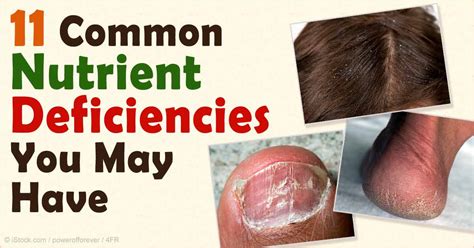 Do You Have Any Of These 11 Common Nutrient Deficiencies Ramsey NJ