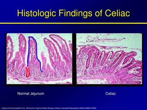 Ppt Celiac Disease And Tropical Sprue Powerpoint Presentation Id
