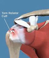 Rotator Cuff Tear Pictures