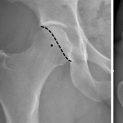 Radiographic Signs Of Acetabular Retroversion In Ap Projections With