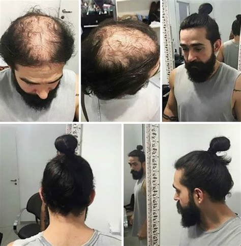 Hiding That Bald Patch With A Man Bun Well You Could Be Risking