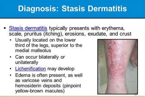 Stasis Dermatitiseczema On Legs Symptoms Causes And Treatment
