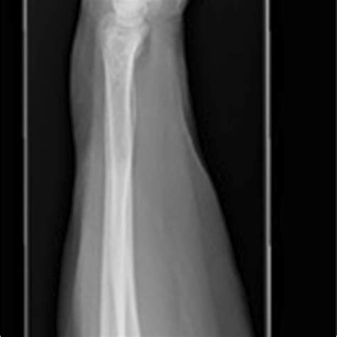 Lateral Radiograph Of The Left Forearm And Wrist Revealed An Expansile