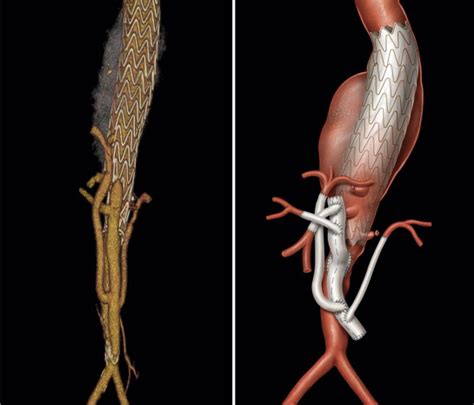 Endovascular Treatment Of Thoracic Aneurysms Thoracic Key