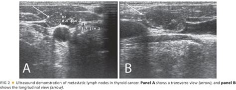 Lymph Node Dissection In Thyroid Cancer Plastic Surgery Key