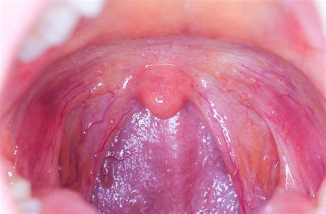 Throat Cancers Link To Oral Sex What You Should Know