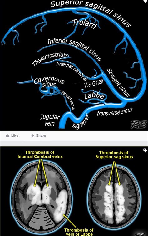 Cerebral Venous Sinuses Anatomy