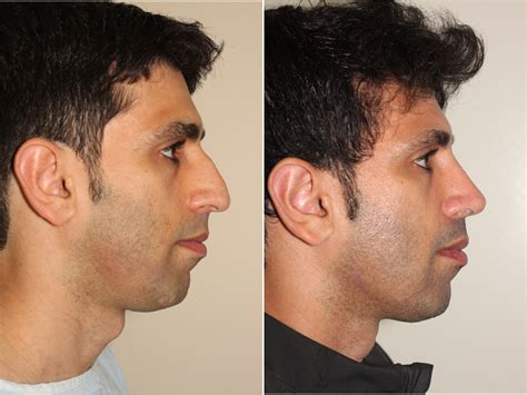 Facial Male Plastic Surgery Telegraph