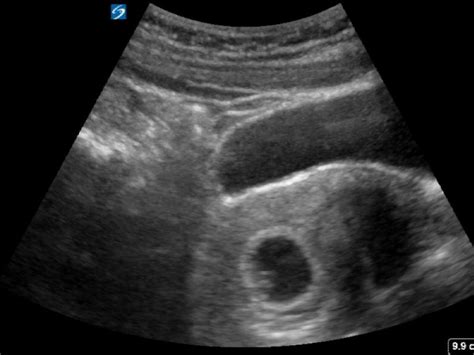 Intrauterine Pregnancy Archives Critical Care Sonography