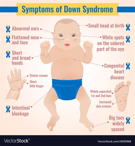 Symptoms Of Down Syndrome Vector Infographic Poster Stock Vector Image