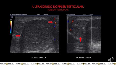 Testicular Torsion Ultrasound Doppler Sexiezpicz Web Porn