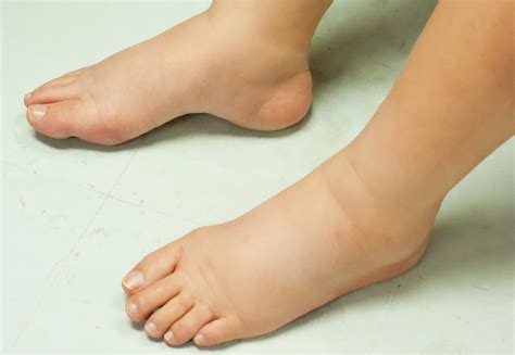 Swollen Ankles And Feet 8 Known Causes Of Foot And Ankle Swelling