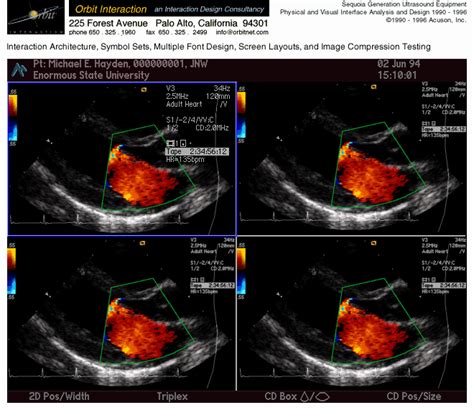 Heart Ultrasound Scan