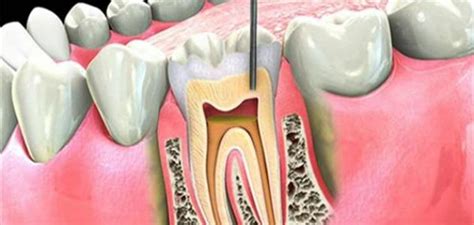 ازالة عصب الاسنان