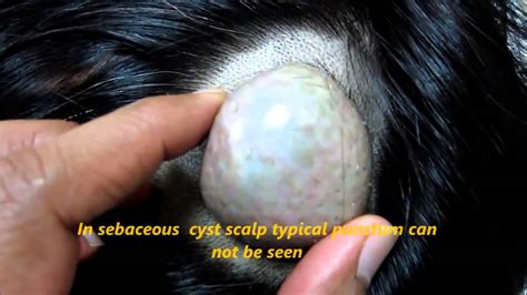 Sebaceous Cyst On Head Huge Youtube