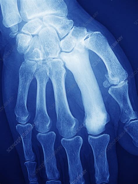 Pagets Disease Of Bone X Ray Stock Image C0213141 Science