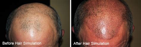 Balding Treatments For Men And Women Thecosmediccorner