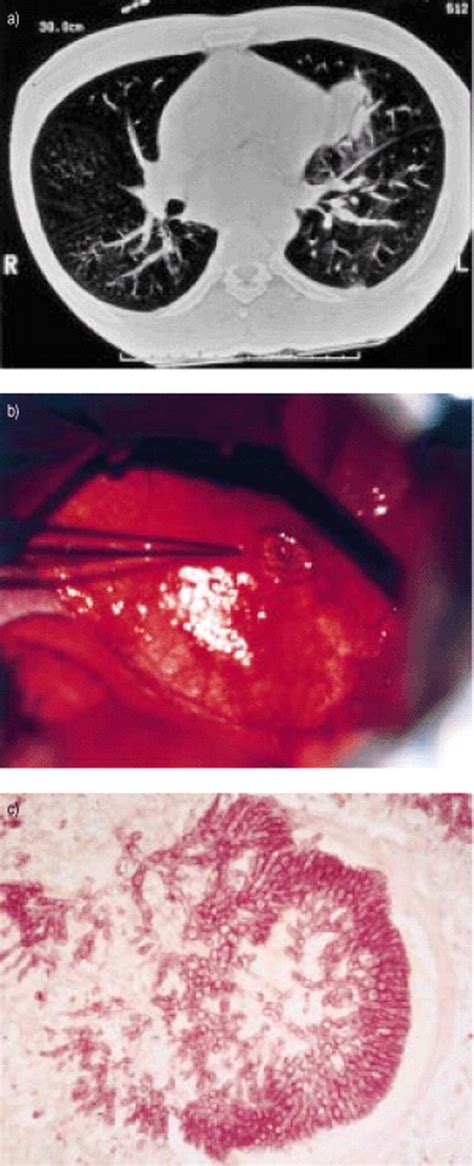 Diagnosis And Treatment Of Invasive Pulmonary Aspergillosis In