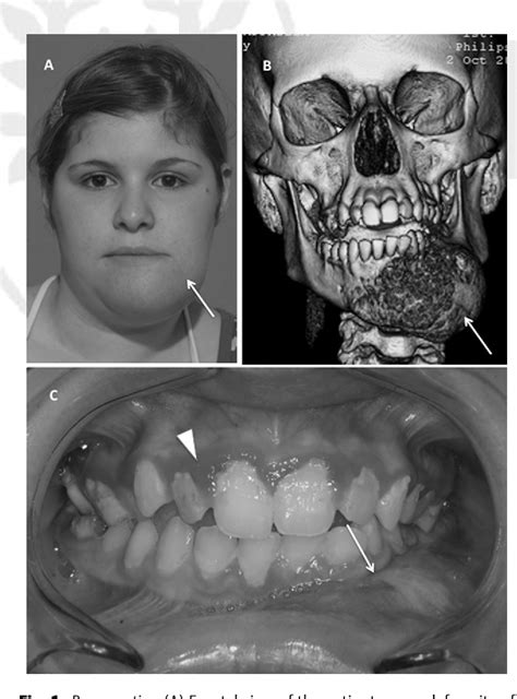 Figure 1 From Microsurgical Reconstruction Of The Mandible In A Patient
