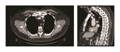 Ct Scan Preoperative Axial And Sagittal Views Of The Tumor White
