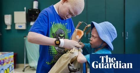 Tanzania Children With Albinism Receive New Limbs After Vicious