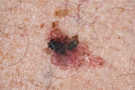 Malignant Melanoma Skin Cancer Cell