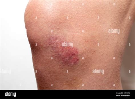 Big Red Bruise On The Knee Injured Knee Joint Hematoma Stock Photo