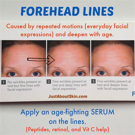 Forehead Lines Just About Skin