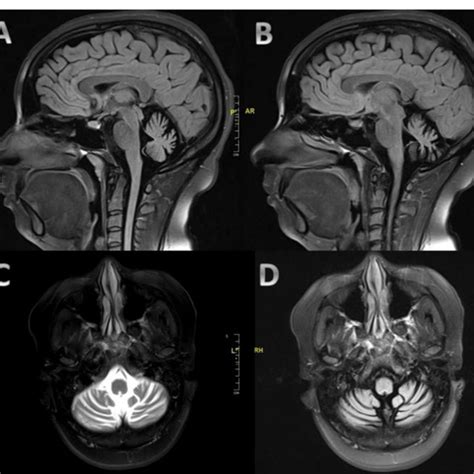 Mri Of The Brain Demonstrating Moderate To Severe Cerebellar Atrophy