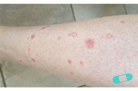 Sunburn (i think), 5weeks on, still itchy, tingling / pins and needles. Itchy Red Bumps & Common Causes - First Derm Blog