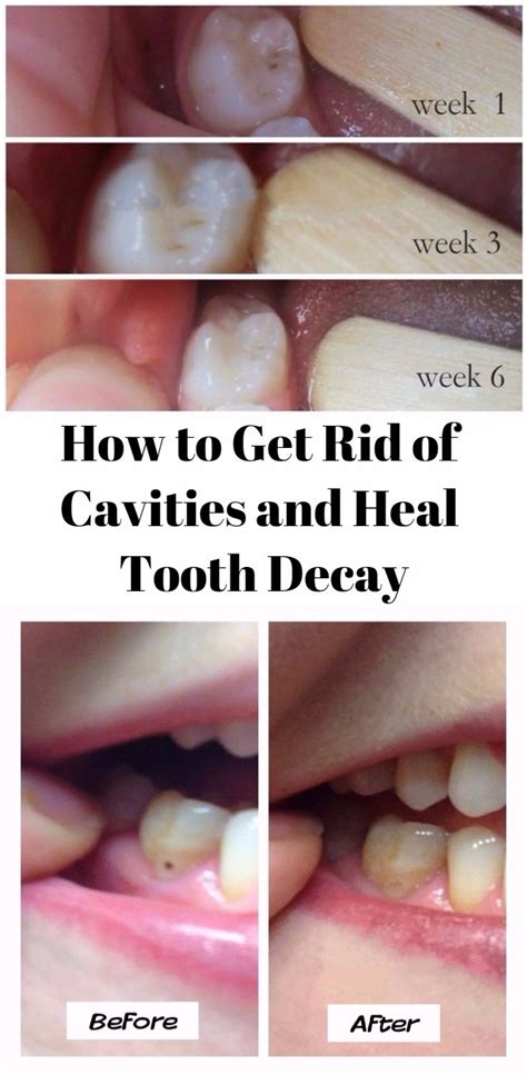 rid  cavities  heal tooth decay health  beauty queen