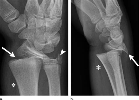 Salter Harris Type I Fracture Of The Distal Radius In A Male Patient
