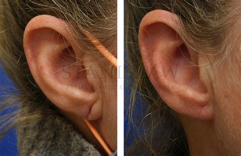 Earlobe Repair Gallery 11 Before And After Photos Connecticut