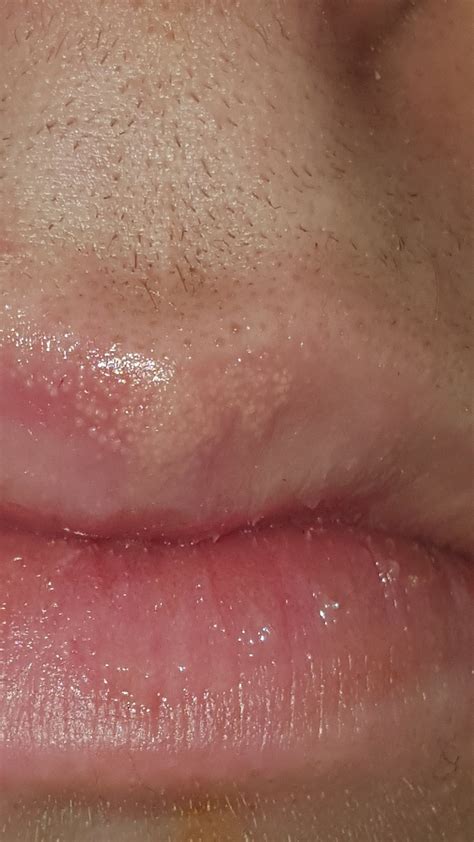 Skin Concerns M16 Cluster Of White Bubbles Inside Upper Lip Skincareaddiction