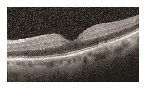 Acute Central Retinal Artery Occlusion Left Eye A Fundus