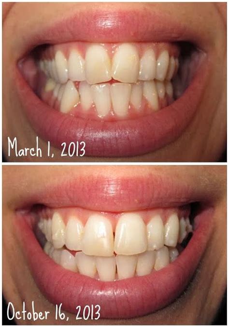 We did not find results for: Invisalign Before and After | My Pics | Pinterest | Teeth ...