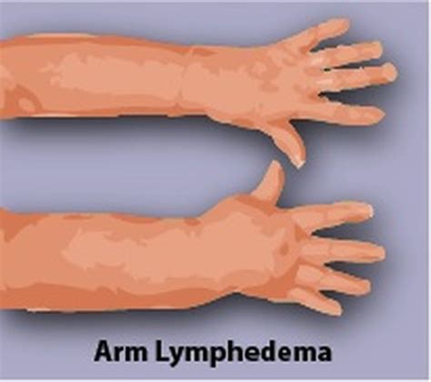 Pin On Lymphedema Exercises