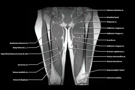 Mri Thigh