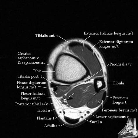 Injuries such as anterior cruciate ligament, meniscus and rotator cuff tears are all easily diagnosed when there is a firm understanding and knowledge of human anatomy. MRI Ankle Anatomy | Anatomy MRI | Pinterest | Bogota ...