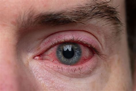 Causes Of Red Rings Around The Eyes Eye Conditions The Eye News