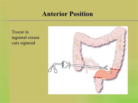 Laparoscopic Sigmoid Colon Resection Supine And Lateral