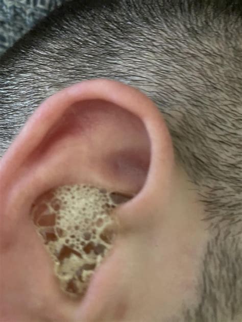 blocked ear peroxide r earwax