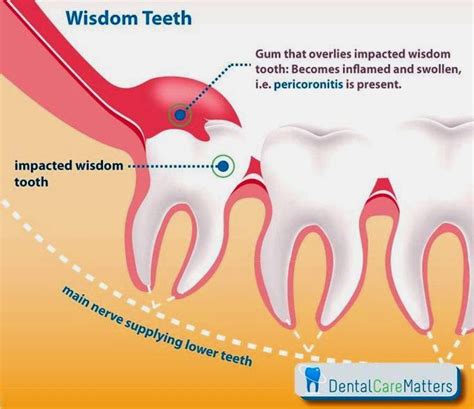 Wisdom Teeth Image Pericoronitis By Molar Impacted
