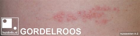 Gordelroos Uitleg Door De Dermatoloog Met Fotos